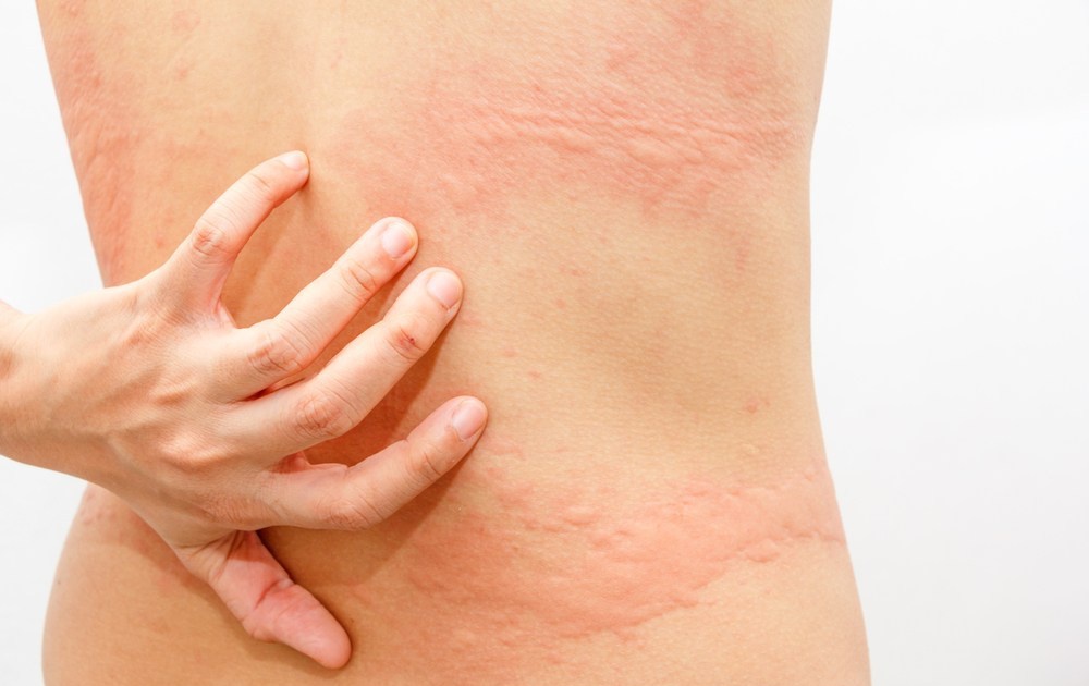 Mẹo Giúp Quần Áo Nhanh Khô Trong Những Ngày Mưa Lê Thê 3 Gây phát ban, mẩn ngứa